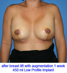 plastic-surgery-breast-lift-augmentation